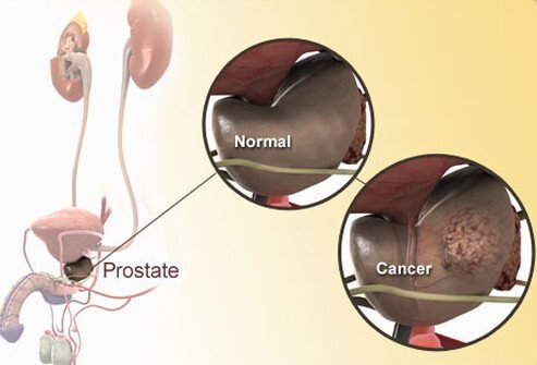 prostatitis teszt a férfiakban